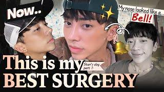 MY NOSE IS PERFECT NOW!│Stan's LIFE-CHANGING rhinoplasty experience at BRAUN! (Part 1)