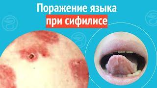  Поражение языка при сифилисе. Клинический случай №1394